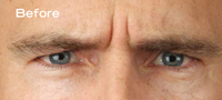 Frown / Glabellar Lines correct with Botox